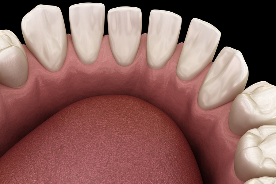 Gaps Between Teeth photo